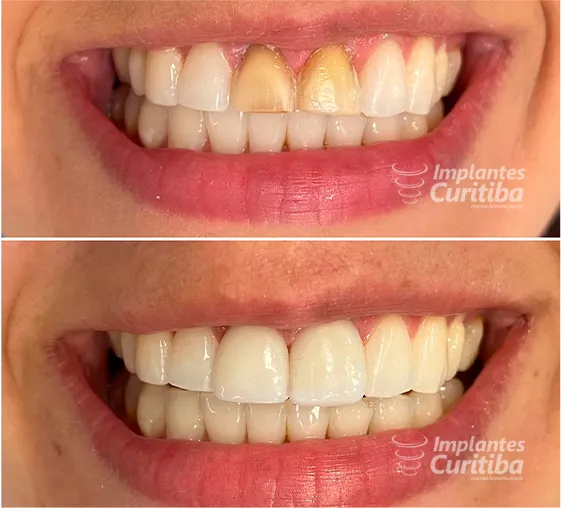 A imagem mostra uma comparação de antes e depois de uma pessoa que colocou as lentes de contato com a Implantes Curitiba.