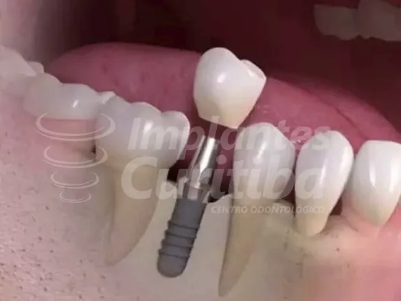 IMPLANTES<br> UNITÁRIOS