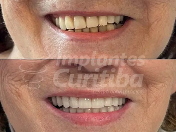 IMPLANTES DE<br> CARGA IMEDIATA