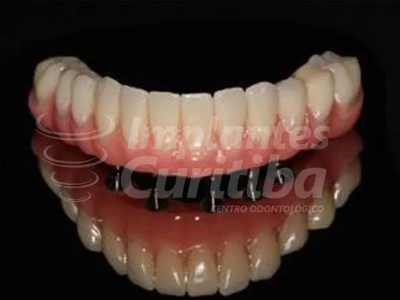 Protocolo Fixo<br> sobre Implantes