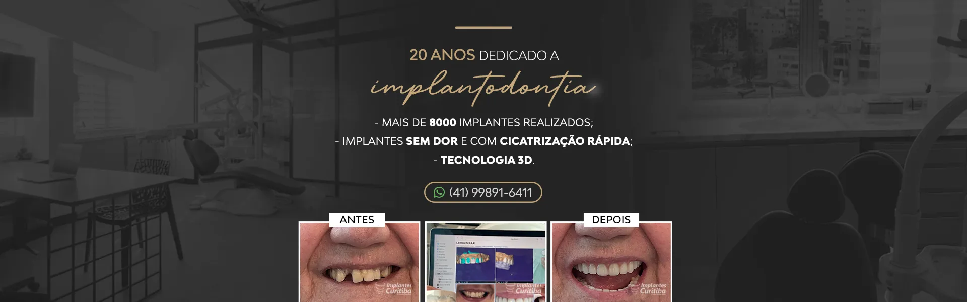 Implantes Curitiba | Imagem ilustrativa