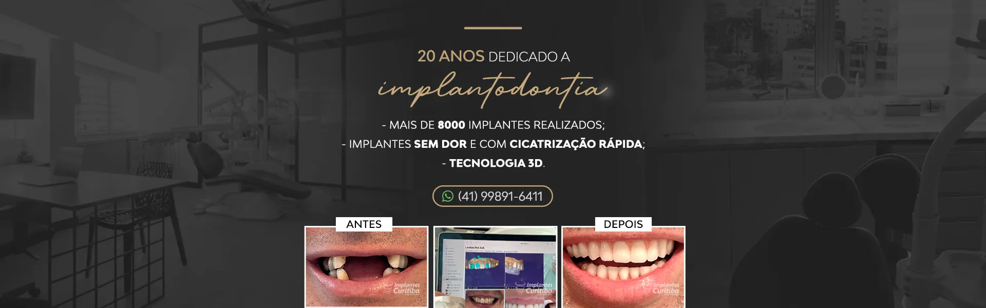 Implantes Curitiba | Imagem ilustrativa